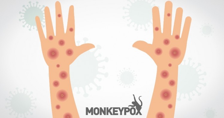 Variole du singe : Voici comment prévenir la transmission du virus Monkeypox